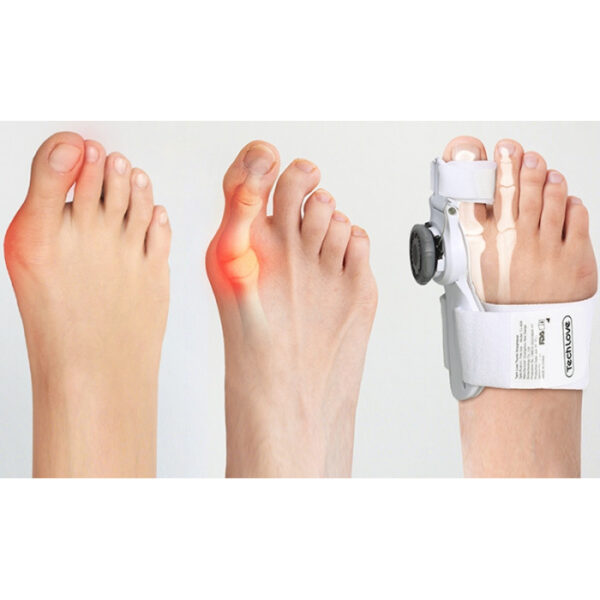 Шина при вальгусі для великого пальця ноги регульована Hallux Valgus - Зображення 5
